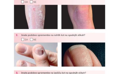 Vprašalnik za odkrivanje suma na psoriazo/luskavico s plaki